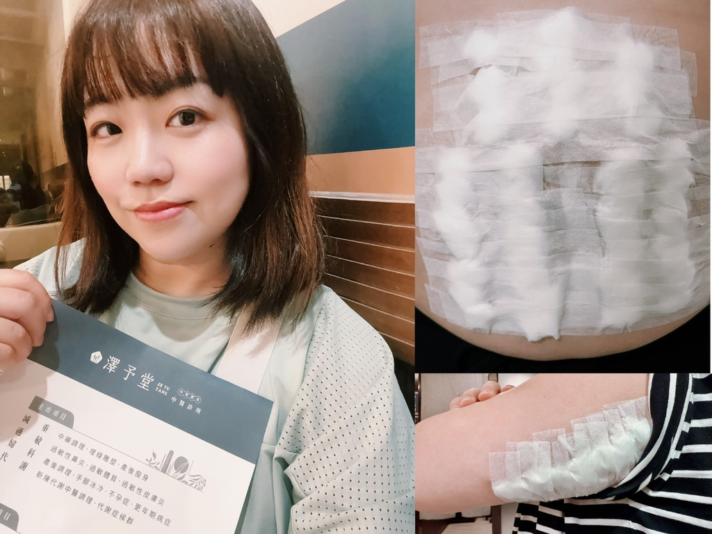 【中醫減重埋線體驗分享】搭配飲食調整 1個月身體更輕盈｜減重