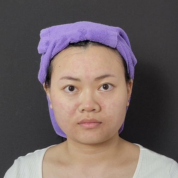 板橋醫美改善膚質美白效果有效嗎台北美白皮秒心得 - 愛爾麗診所板橋分店 (7).jpg
