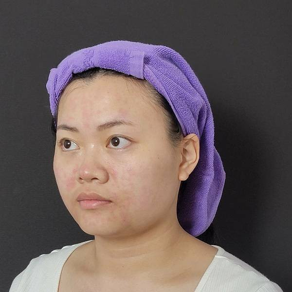 板橋醫美改善膚質美白效果有效嗎台北美白皮秒心得 - 愛爾麗診所板橋分店 (5).jpg