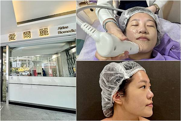想加強輪過線就用這個！非侵入式治療-HIPEO-S龍捲風音波拉提，無痛拉提新選擇！輪廓線醫美體驗心得 愛爾麗診所